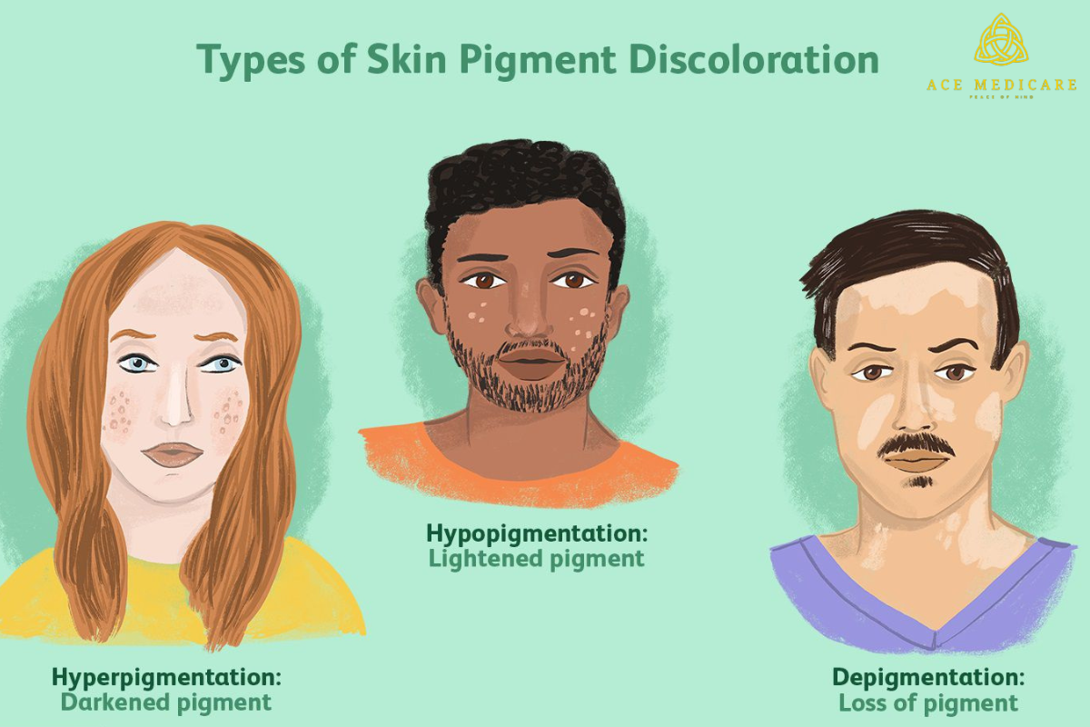 Skin Pigmentation Disorders: Types, Symptoms, and Management